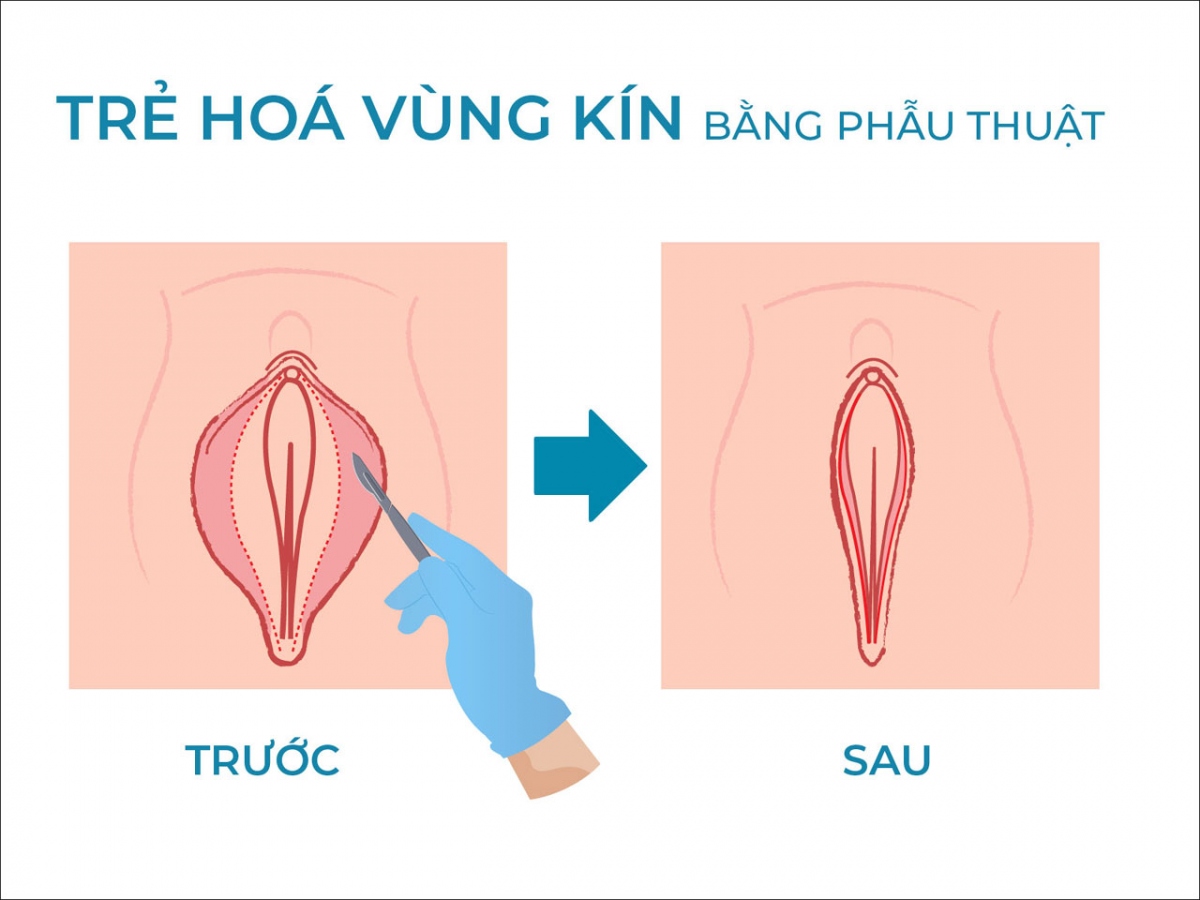 Thẩm mỹ vùng kín cải thiện kích thước, hình dáng, sự đàn hồi của vùng kín, đồng thời hỗ trợ lấy lại cảm giác tại khu vực này cho chị em phụ nữ