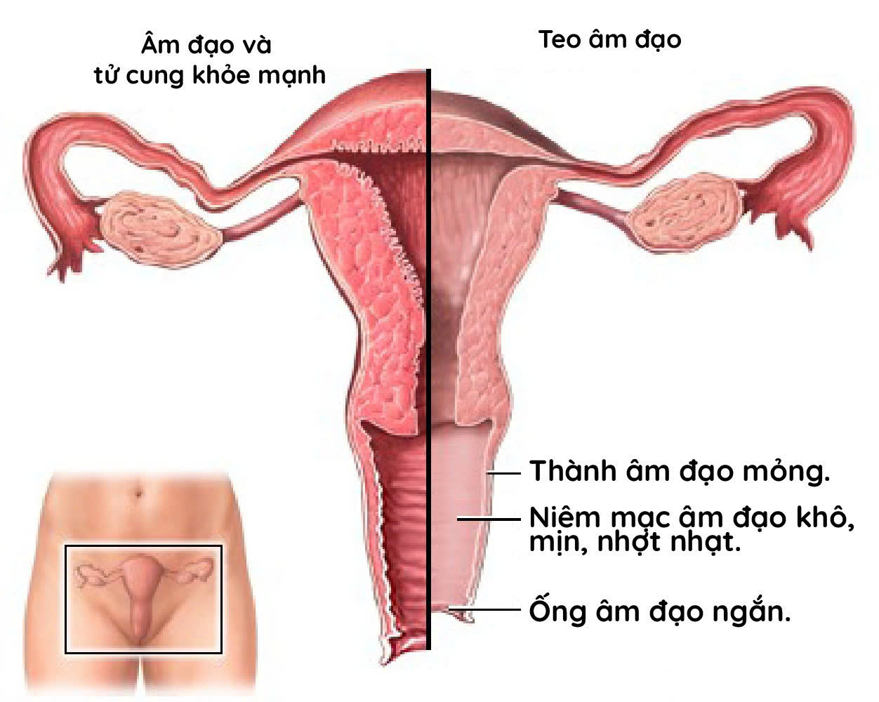 So sánh cấu trúc âm đạo trước và sau mãn kinh