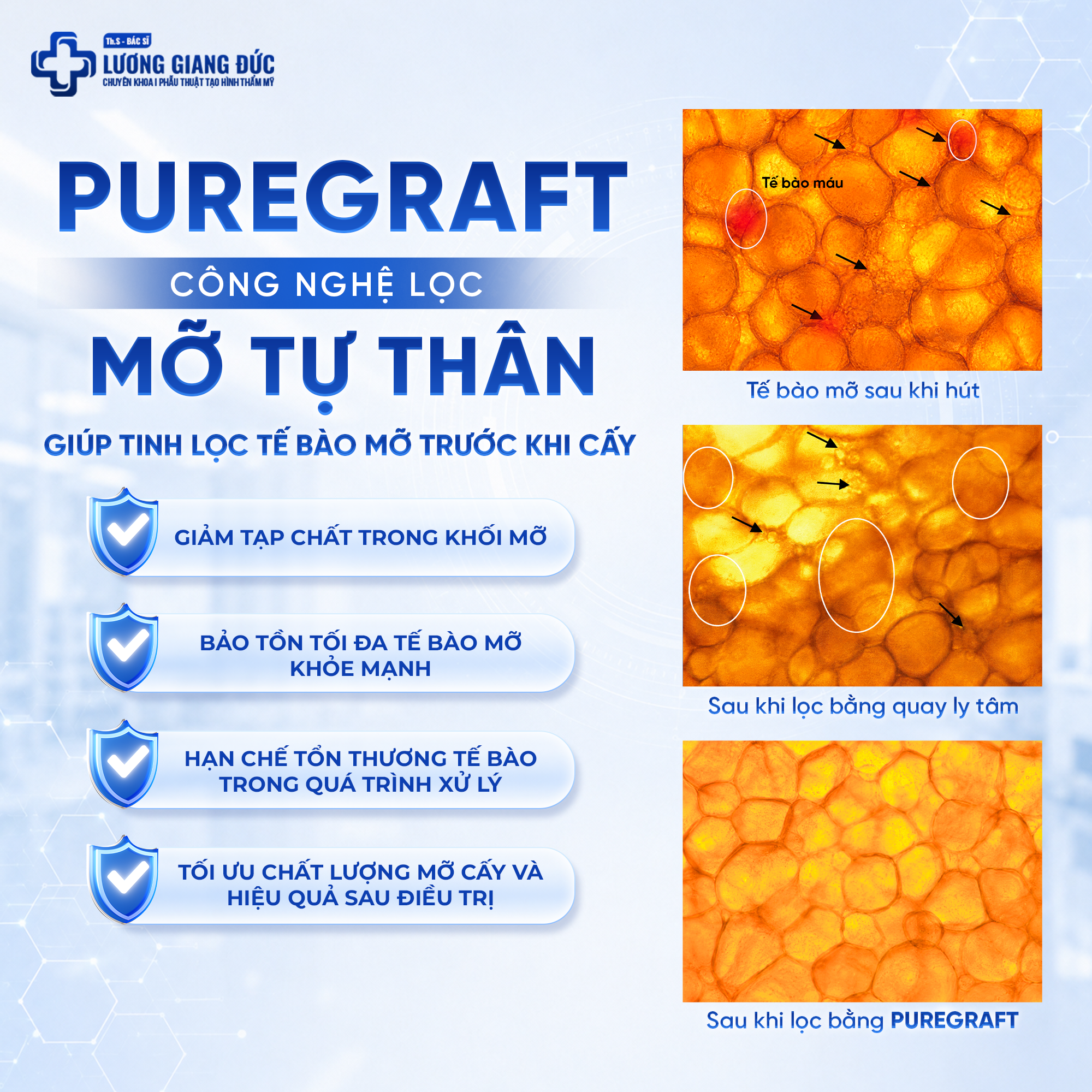 Công nghệ lọc mỡ Puregraft ứng dụng trong cấy mỡ tự thân